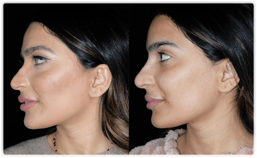 Non Surgical Nose Jobs In Mississauga And Toronto Lip Doctor